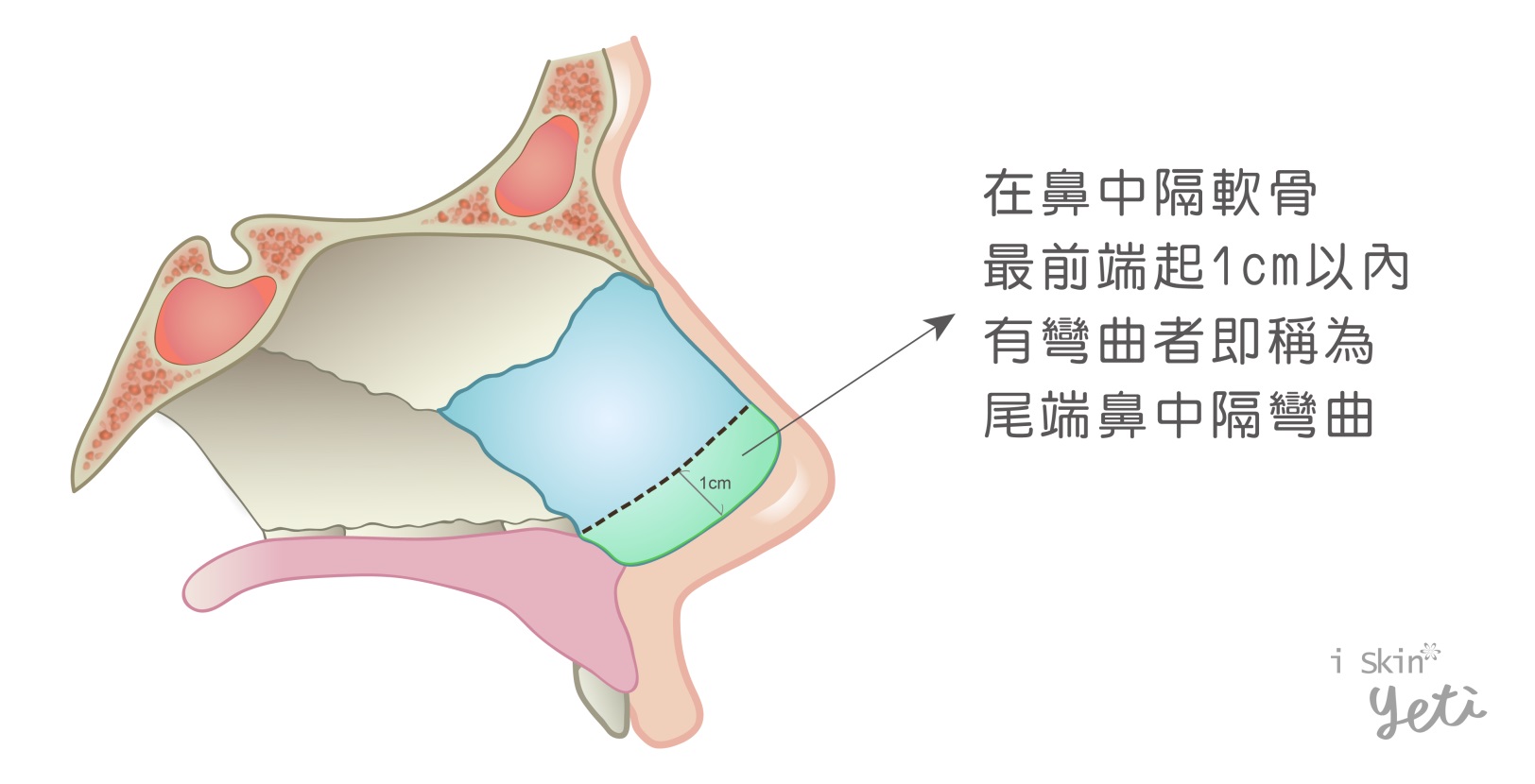 尾端鼻中隔彎曲圖示，綠色區塊為尾端鼻中隔軟骨，若此處有彎曲情況，則稱為尾端鼻中隔彎曲。